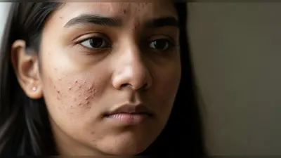 चेहरे के मुंहासों का नया कारण: शोध में खुलासा, तांबे की कमी से बढ़ते हैं मुंहासे और निशान!